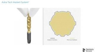 Implant Pick-Up Design EV – Impression taking procedure | Dentsply Sirona