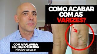 COMO ACABAR COM AS VARIZES? Eu sou médico vascular você sabia? | Dr Dayan Siebra #varizes #saude