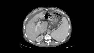 Transjugular Intrahepatic Portosystemic Shunt (TIPS)