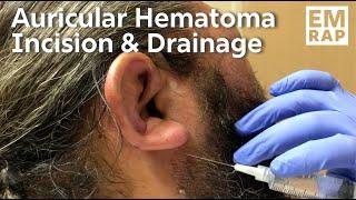 Auricular Hematoma Incision and Drainage with Bolster Compression Dressing