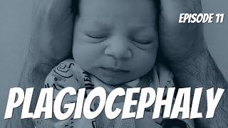 PLAGIOCEPHALY