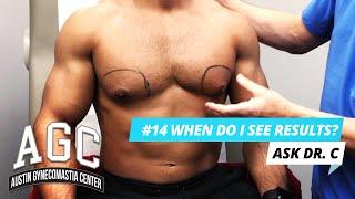 When Will I See Results After Gynecomastia Treatment? - Ask Dr. C - Episode 14