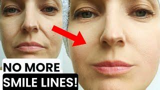 HOW TO GET RID OF SMILE LINES, NASOLABIAL FOLDS, MARIONETTE LINES, SMOKER LINES