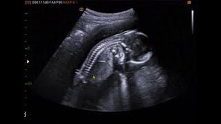 fetal ultrasound of 16 weeks 17 weeks baby boy moving