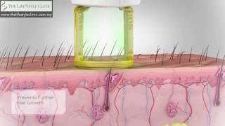 Gentle Hair Removal - GentleMax Pro Laser animation