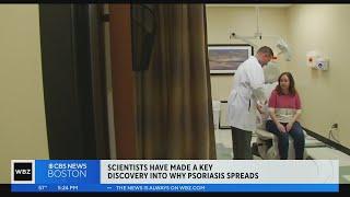 New discovery on how psoriasis spreads may lead to more effective treatments