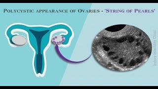 Polycystic Ovaries (PCOD / PCOS) | How they appear on Ultrasound / Sonography | String of Pearl