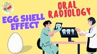 EGG SHELL EFFECT - Oral Radiology - simple explanation - 5 min Dentistry