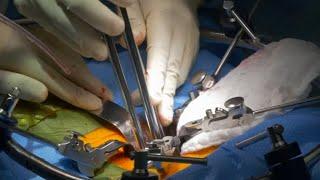 Lumbar artificial disc replacement