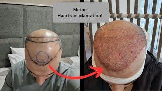 RÜCKBLICK auf die Haartransplantation nach 4 Wochen!