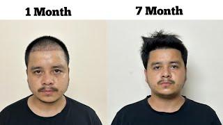 My 7 month Hair Transplant results / Hair Transplant in Nepal / Rabin thapa