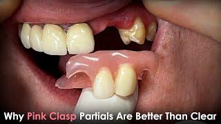 Why Pink Clasp Partials Are Better Than Clear Clasp Partials