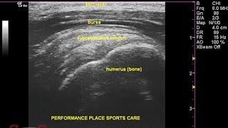 How to Read MSK Ultrasound of the Shoulder