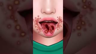 ASMR Stomatitis Treatment Because of Eating Hot Spicy #shorts