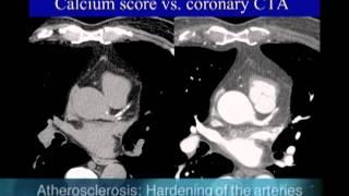 UCSF Radiology: Calcium Scoring vs. Coronary CTA Scan