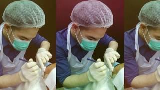 Dr Foo Wing Jian of Premier Clinic performed the FUE hair transplant procedure