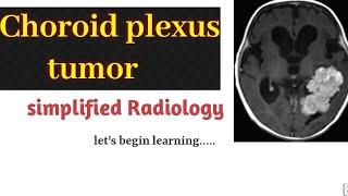 Unveiling the Secrets of Choroid Plexus Tumors  #radiology  #ChoroidPlexus #BrainTumorDiagnosis"