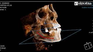 Virtual Implant Treatment Plan Simulation