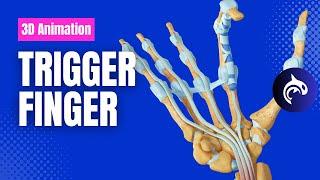 Trigger Finger: See the Condition and Surgery - 3D Animation