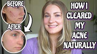 How I Healed My Cystic Acne Naturally + My Updated Guide To Beating Adult Acne