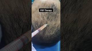 PRP v/s GFC Therapy for Pattern Hair Loss AMAZING Results #prptherapy #gfctherapy #hairlosstreatment