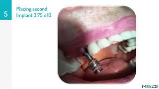 Implantation Procedure using MSDI dental implants (Alef Implant) - by Dr. Raul Rojas