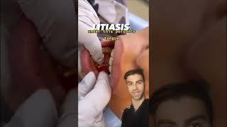 Salivary Gland Stone Removal