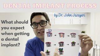 Dental Implant Process: What To Expect When Getting Dental Implants?