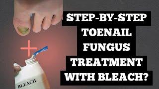 How to get rid of toe nail fungus with bleach: For people who don't mind alternative treatments