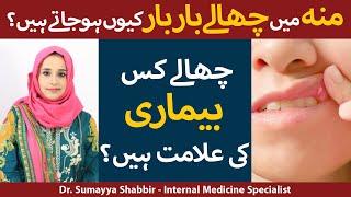 Moun Main Chalon Ka Ilaj | Munh Mein Chhale Kyon Hote Hain | Mouth Ulcer Treatment In Urdu