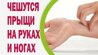 Что делать, если прыщи на руках и ногах чешутся