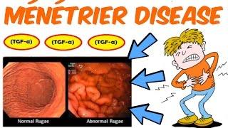 Ménétrier's Disease- Your Stomach Causing You Sorrow?