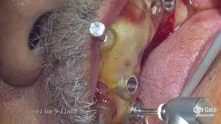 Guided Implant Placement for Implant assisted Overdenture  #4,6,11,13,22,27