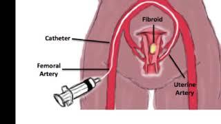 SIR-MSC: Uterine Fibroid Embolization