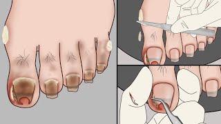 ASMR Ingrown Toenail Removal Treatment Animation~Strong Satisfaction!  | Meng's Stop Motion
