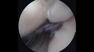 Arthroscopic Repair of Medial Meniscal Posterior-Root Tear: Drilling Transosseous Tibial Tunnel