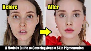 How I Cover My Acne, Acne Scars, & Skin Pigmentation | A Model's Tips *Easy, Non-Cakey*