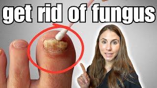 Get Rid Of Toenail Fungus With These 4 Easy Home Remedies