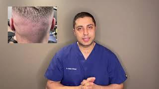 Will There Be Scarring After A Hair Transplant? | Juvida Clinics