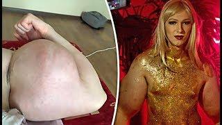 Synthol Freak Now Wants To Be A Woman And A Massive BOOB Job