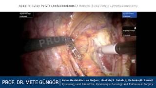 Robotik Bulky Pelvik Lenfadenektomi - Robotic Bulky Pelvic Lymphadenectomy / Da Vinci