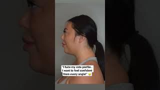 How To Lose Facial Fat | Buccal fat removal and chin liposuction #beforeandafter
