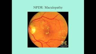 Diabetic Retinopathy - CRASH! Medical Review Series