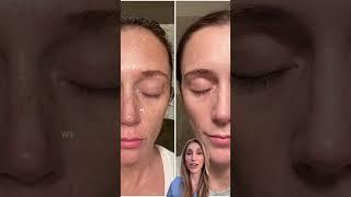 How I transformed my melasma patient's skin in 4 months!