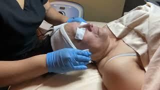 Microdermabrasion #2 (Nikki Duaban)