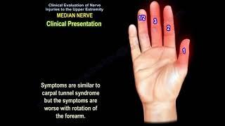 Median nerve injury, causes, symptoms, diagnosis and treatment. Carpal tunnel syndrome diagnosis.