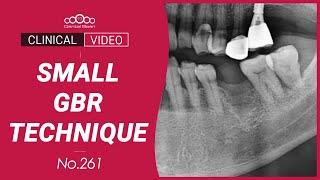 Implant placement with small GBR by Wide Cover Cap - [Dr. Jeon Inseong]