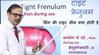 Tight frenulum | pain in sex | frenuloplasty | Dr.(Prof)Santosh Kumar PGI