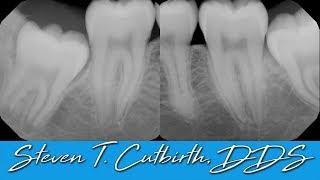 Extraction of Four Impacted Wisdom Teeth
