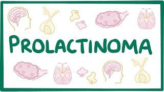 Prolactinoma - causes, symptoms, diagnosis, treatment, pathology
